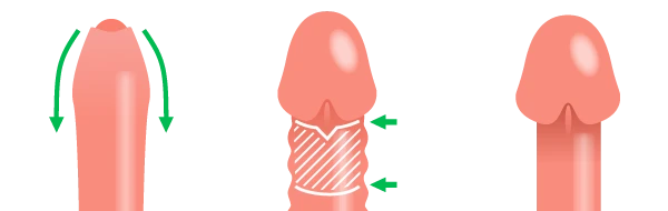 マイクロVカット法