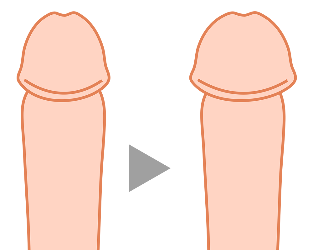 亀頭増大